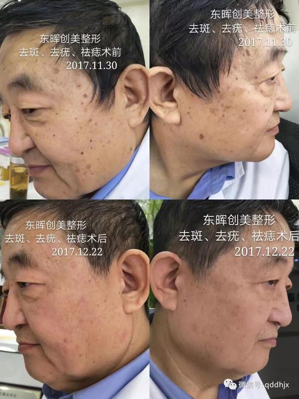 老年性点状白斑:老年性白点病,是皮肤老化的一种表现,常见于躯干四肢