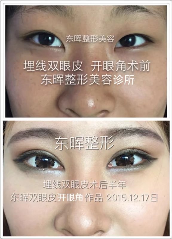 双眼皮开眼角对比照片.jpg